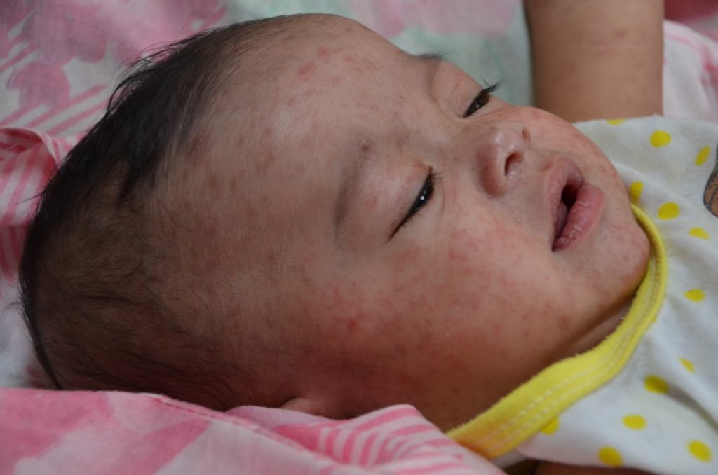 outbreaks of measles